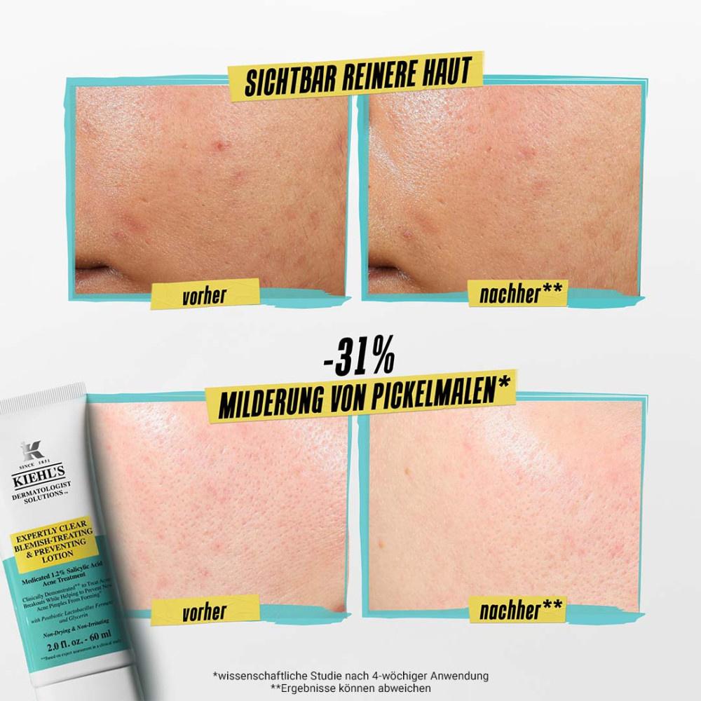 Produktbild KIEHL'S Expertly Clear Blemish Treating&Preventing Lotion 4 von 7
