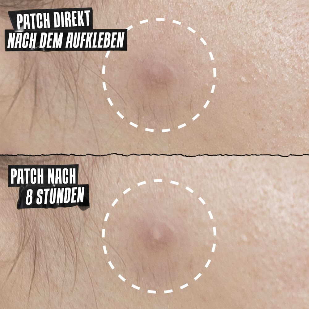 KIEHL'S Truly Targeted Overnight Blemish Patches