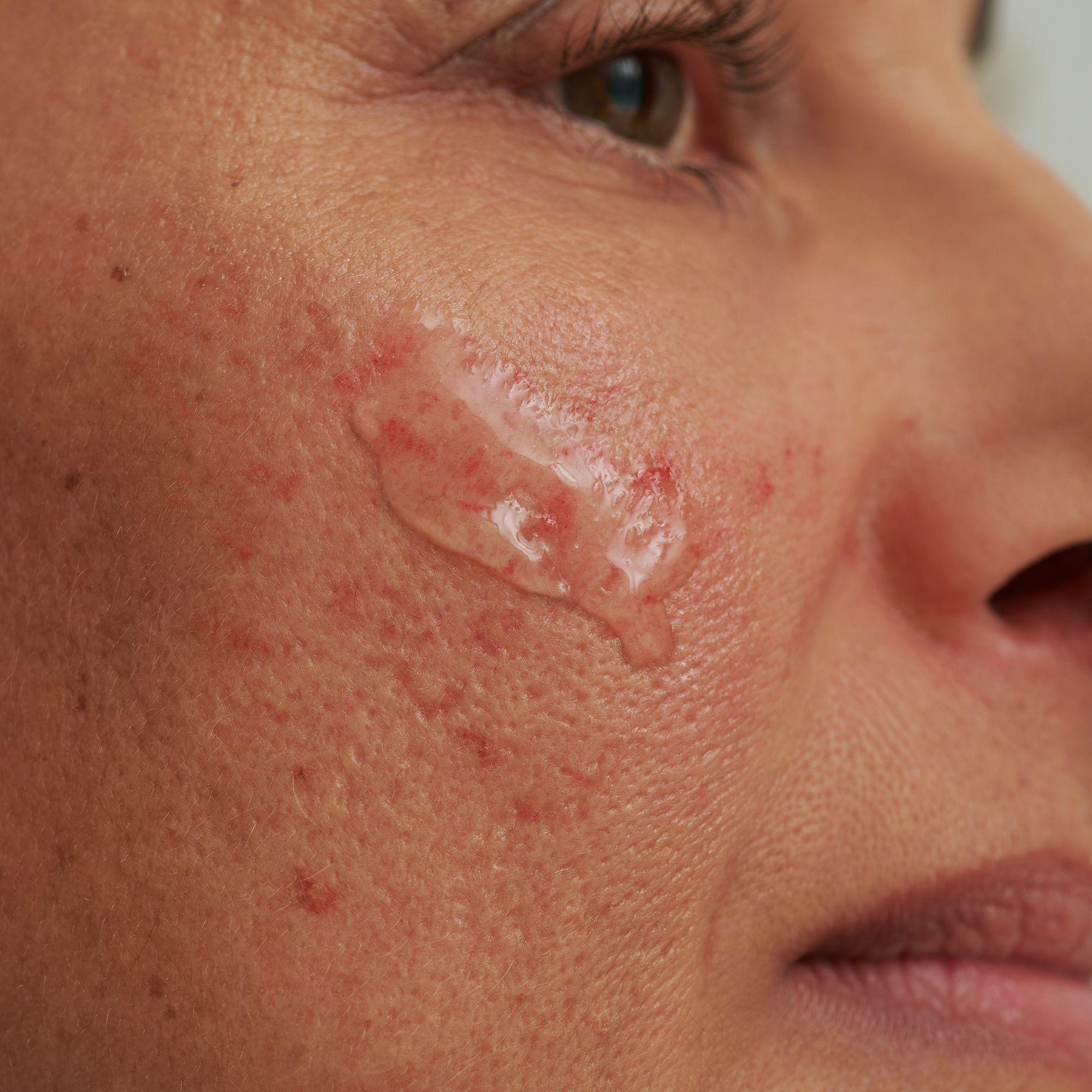 Produktbild DADO SENS SENSACEA Intensivserum - bei hypersensibler Haut&Couperose 2 von 9