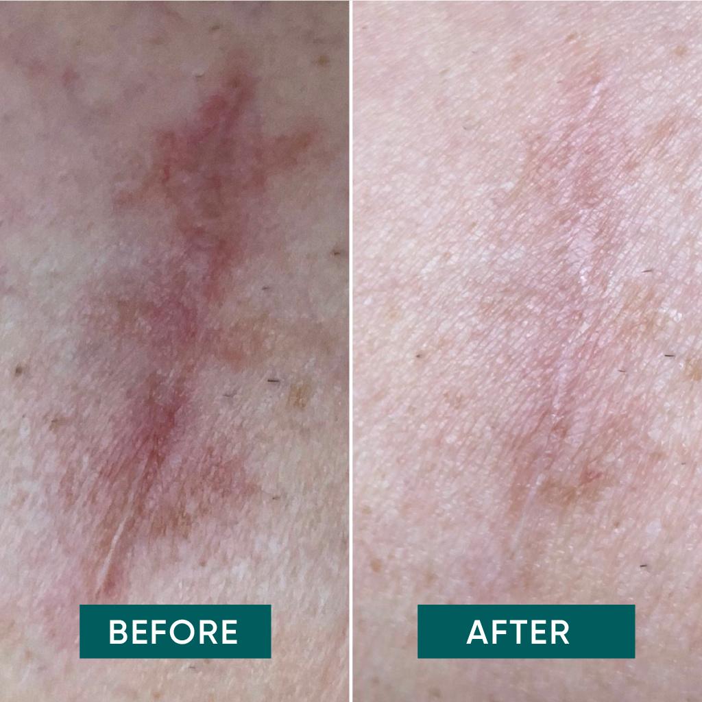 Produktbild APRICOT Narben Pads klein 5 von 5