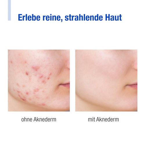 Produktbild Aknederm Reinigungsschaum 5 von 8