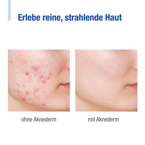 Produktbild Aknederm Tinktur 2 von 8