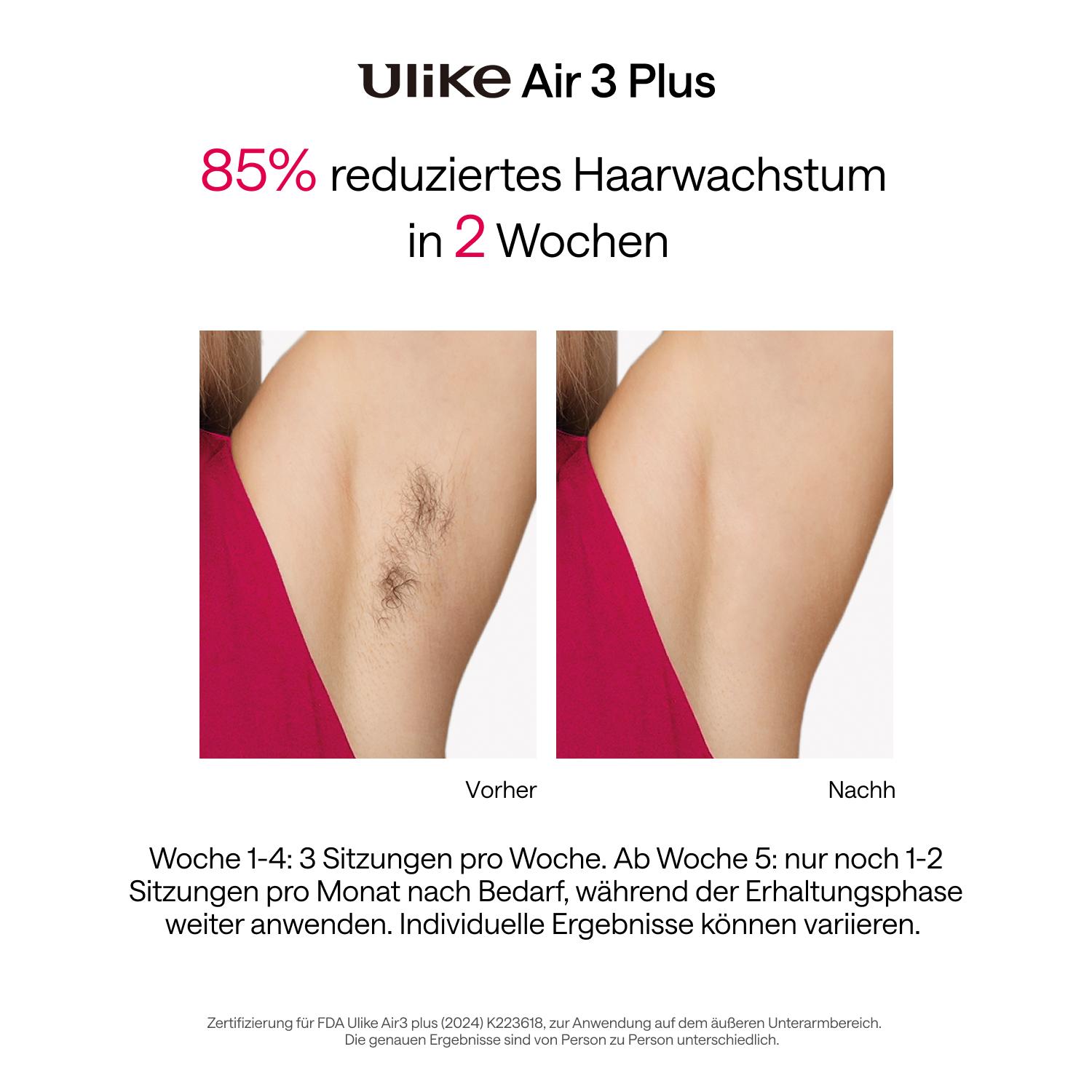 Produktbild ULIKE Air 3 plus IPL-Haarentfernungsgerät 4 von 7